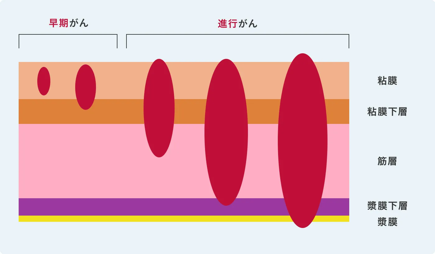 早期がんと進行がん