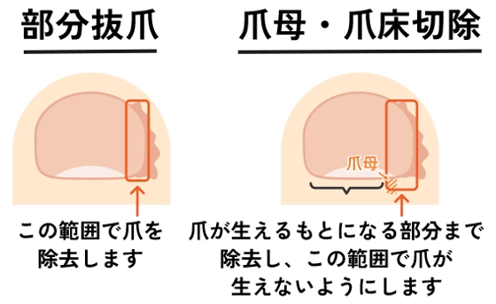 部分抜爪と爪母・爪床切除の図解