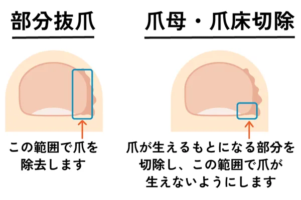 部分抜爪と爪母・爪床切除の図解
