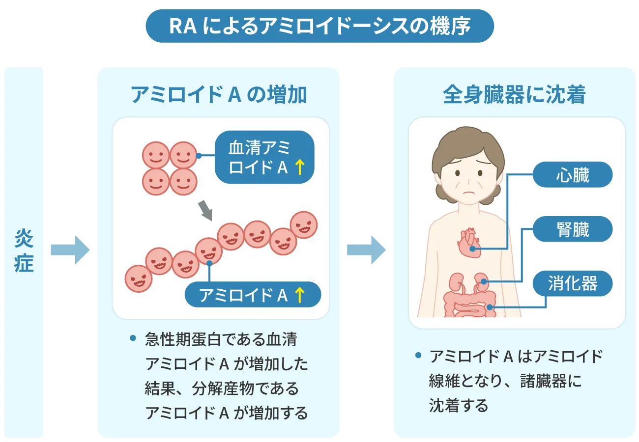 RAによるアミロイドーシスの機序