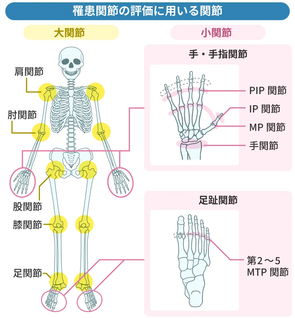 罹患関節の評価に用いる関節