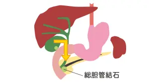 イラスト: 総胆管結石