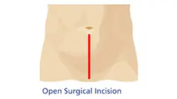 図: 開腹手術（従来手術） の傷口